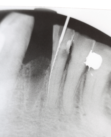 Endodontia: O Tratamento de Canal e a Importância da Saúde do Dente - parte II