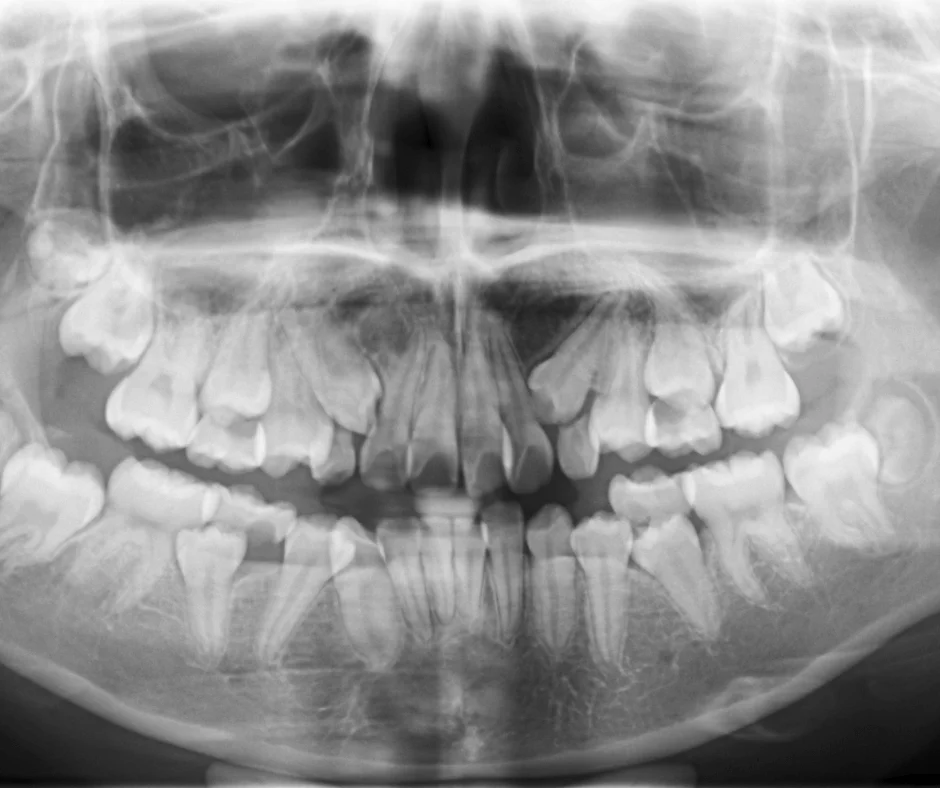 Fatos Surpreendentes Sobre a Dentição Humana: radiografia odontológica com dentes supranumerários