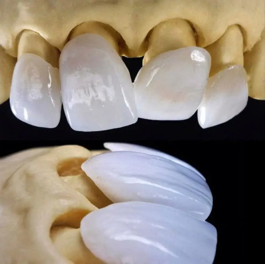 Sorriso Eterno: Facetas Laminadas de Porcelana 2 Facetas dentárias dentes anteriores, no modelo de trabalho