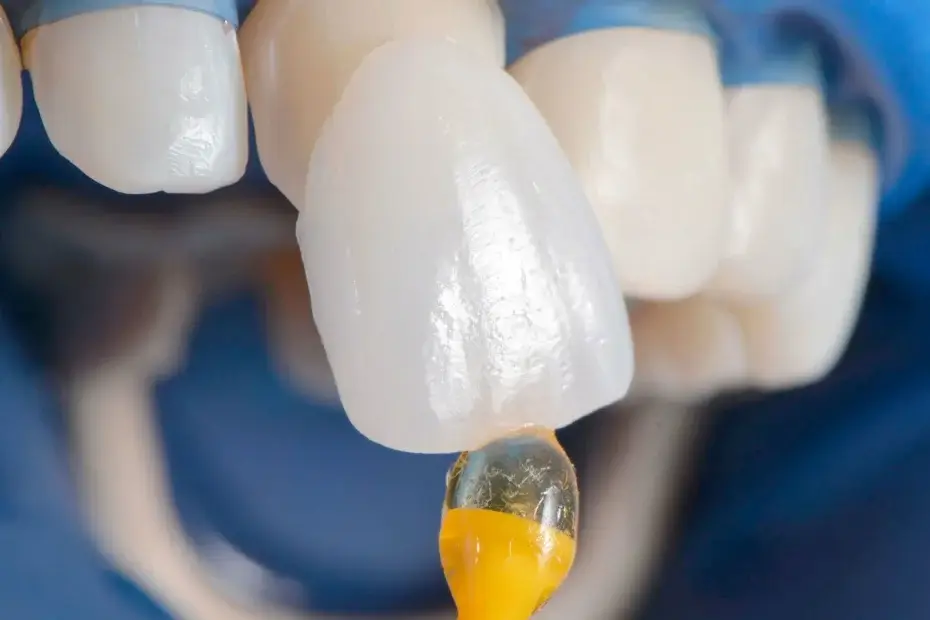 facetas dentárias em dentes anteriores